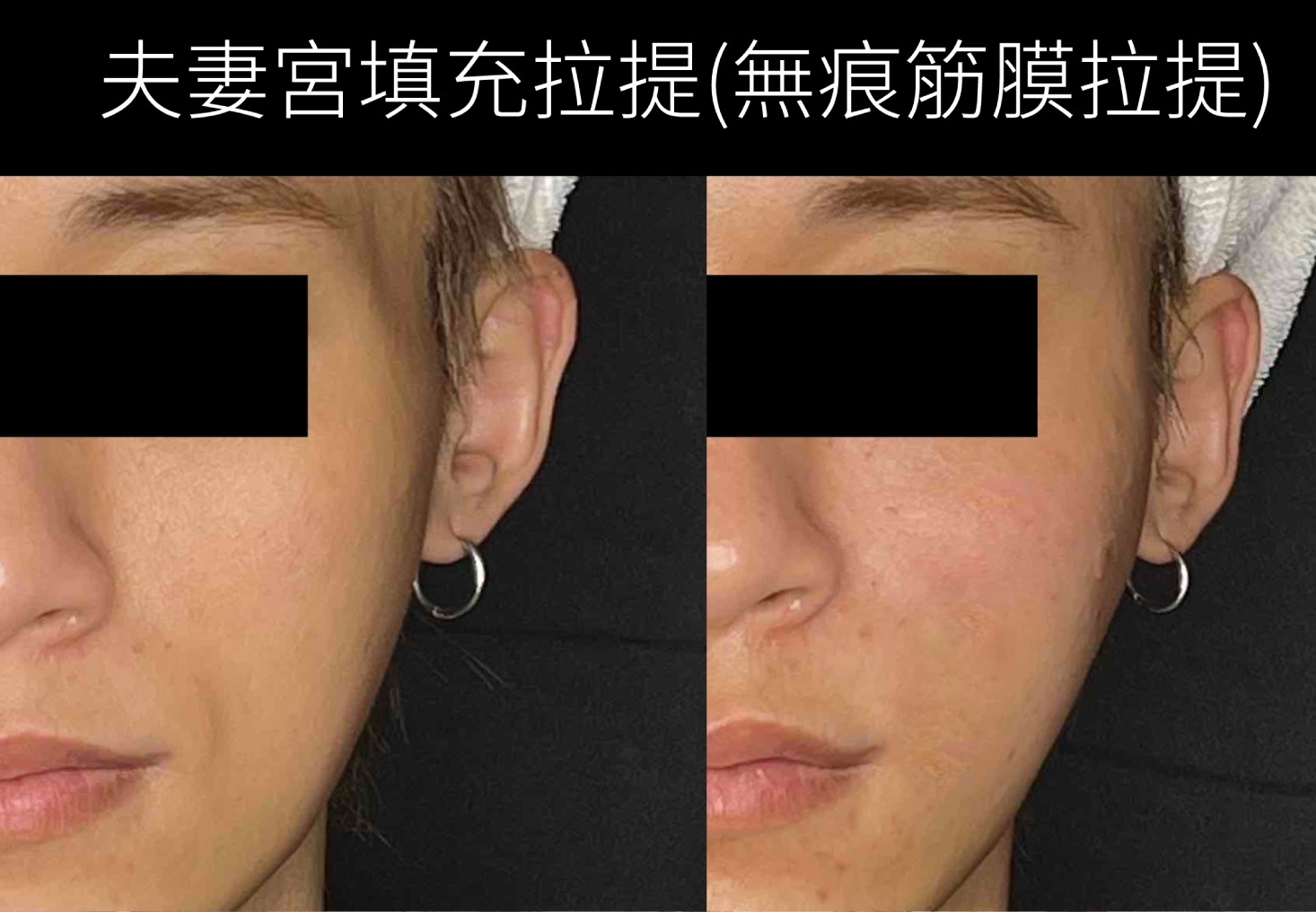 告別疲憊兇相！針劑填充夫妻宮